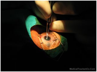 The most current technology for cataract removal (in people or animals) involves  the. Cataract treatment (workup, anesthesia, surgery) generally costs between.