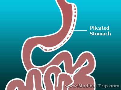 Laparoscopic Gastric Plication