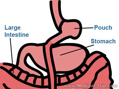 Self-Pay Gastric Bypass | Medical Trip