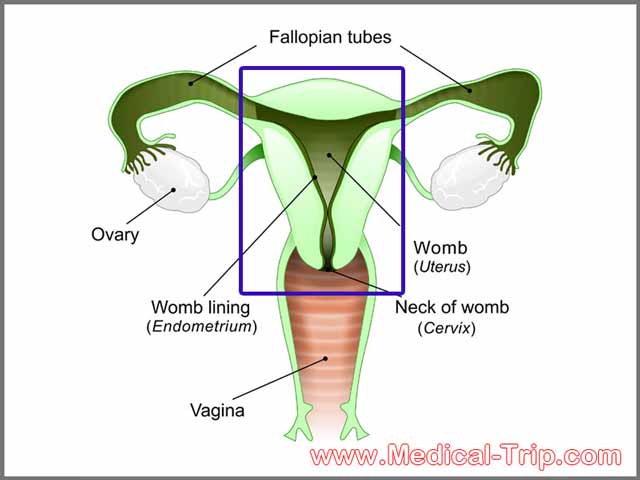 Hysterectomy in Mexico | Medical Trip